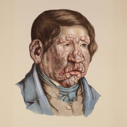 J. L. Losting. Mann med lepra, Lepramuseet St. Jørgens Hospital, Bymuseet i Bergen