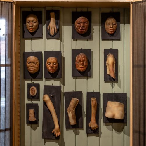 Wax models. Photo: Bergen City Museum. Objects belong to the Bergen Collections on the History of Medicine.